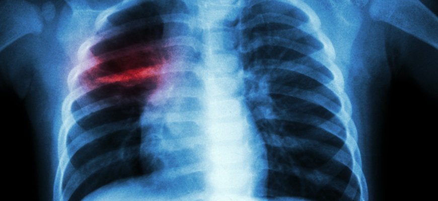 Tu gali save ir savo artimą apsaugoti nuo tuberkuliozės