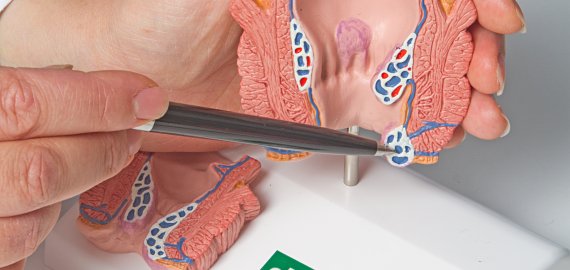 Lėtinis prostatitas: kodėl būtina efektyviai gydyti šią ligą?