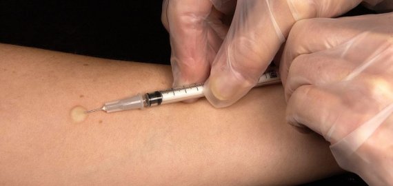 Sakome „ne“ vaikų tuberkuliozei