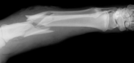 Vyras dėl podukros smurto kreipėsi tik po mėnesio- pastebėjo, kad lūžusi ranka