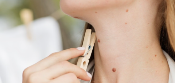 Kodėl verta šalinti apgamus?