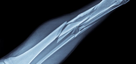 Eismo įvykio metu senjoras sulaužė koją senjorei